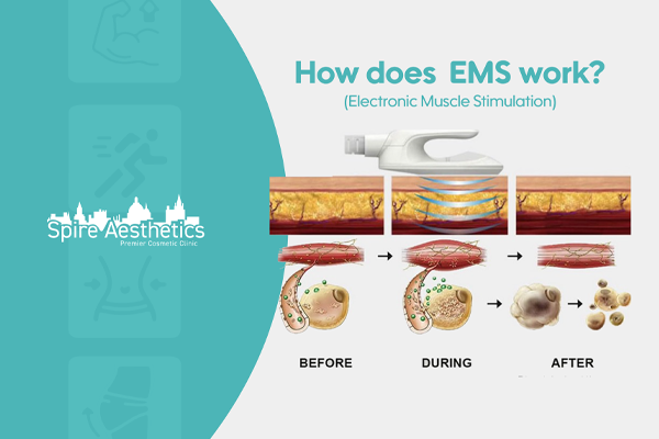 EMS treatment for post pregnancy weight loss treatment Bellshill