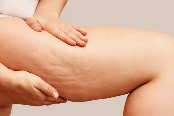 Image of woman showing leg with cellulite Bellshill