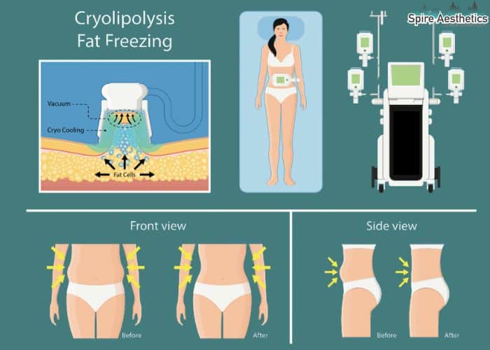 Image of diet and fat freezing combined for best results for Spire Aesthetics Bellshill