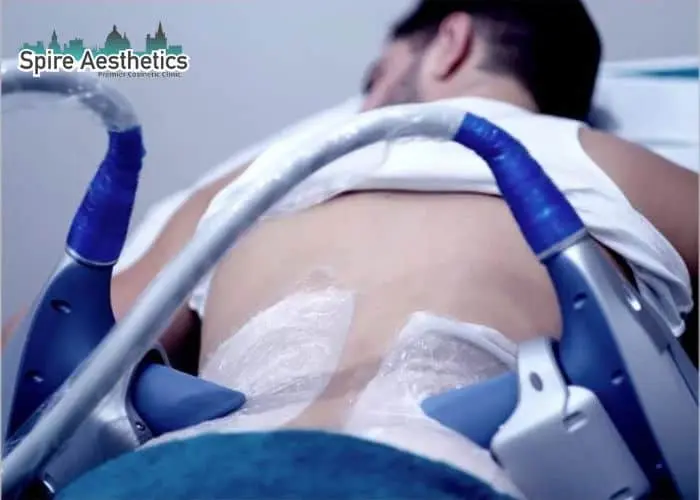 Man having fat freezing treatment done on love handles before a competitions Bellshill to create a sculpted look.