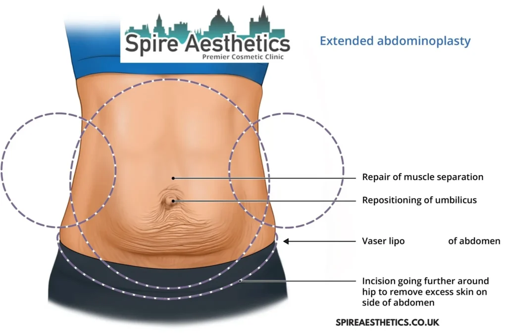 Understanding Loose Skin After Gastric Band Bellshill Surgery and HIFU Treatment 