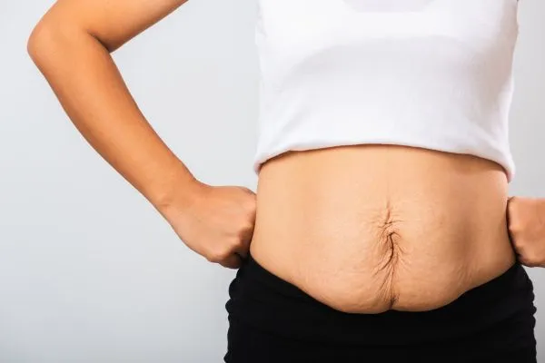 Image of a woman's stomach after weight loss with sagging skin following a gastric band Bellshill