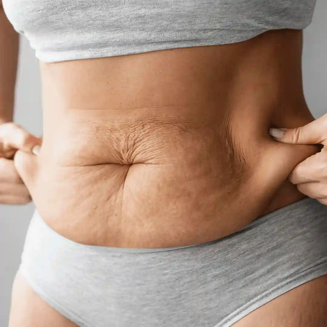Is It Normal to Have Loose Skin After Pregnancy Bellshill?