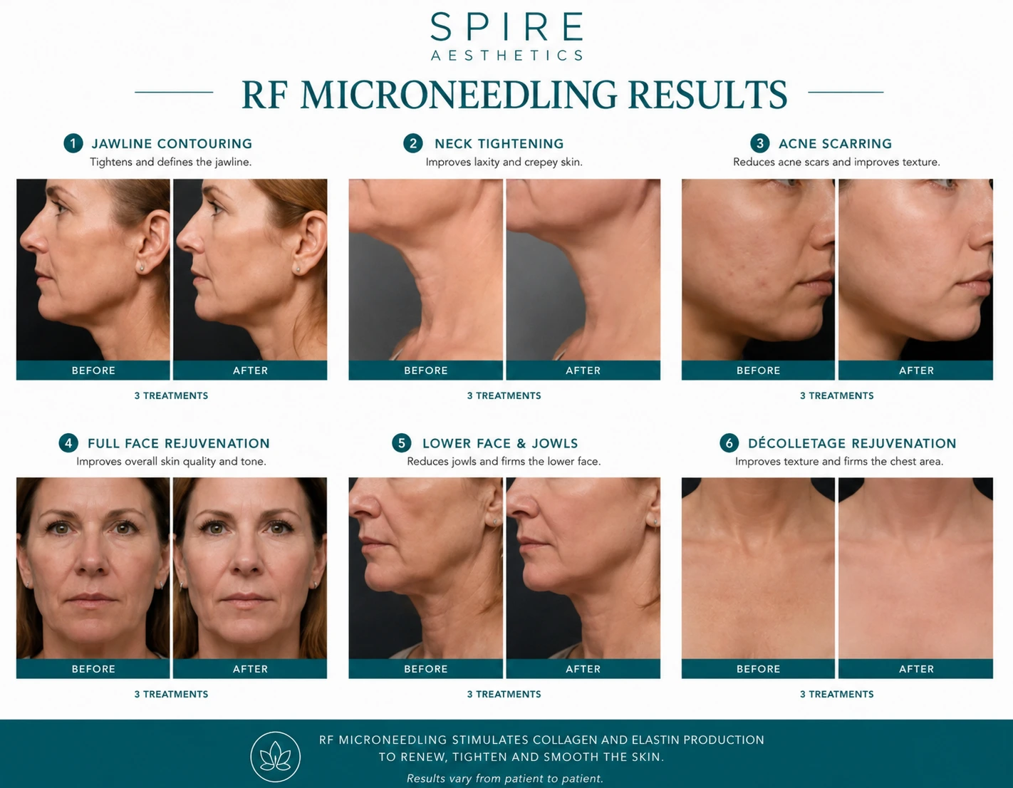 RF Microneedling Skin tightening Bellshill results
