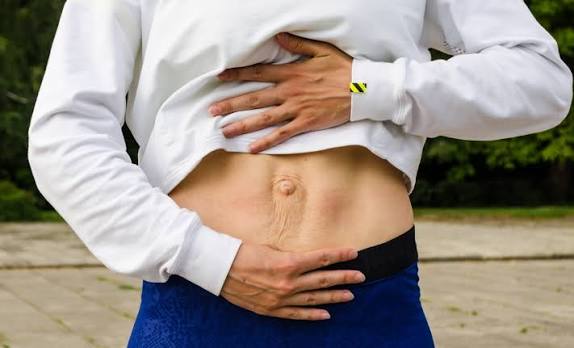 When Could Diastasis Recti Be the Missing Piece of the Puzzle Bellshill?