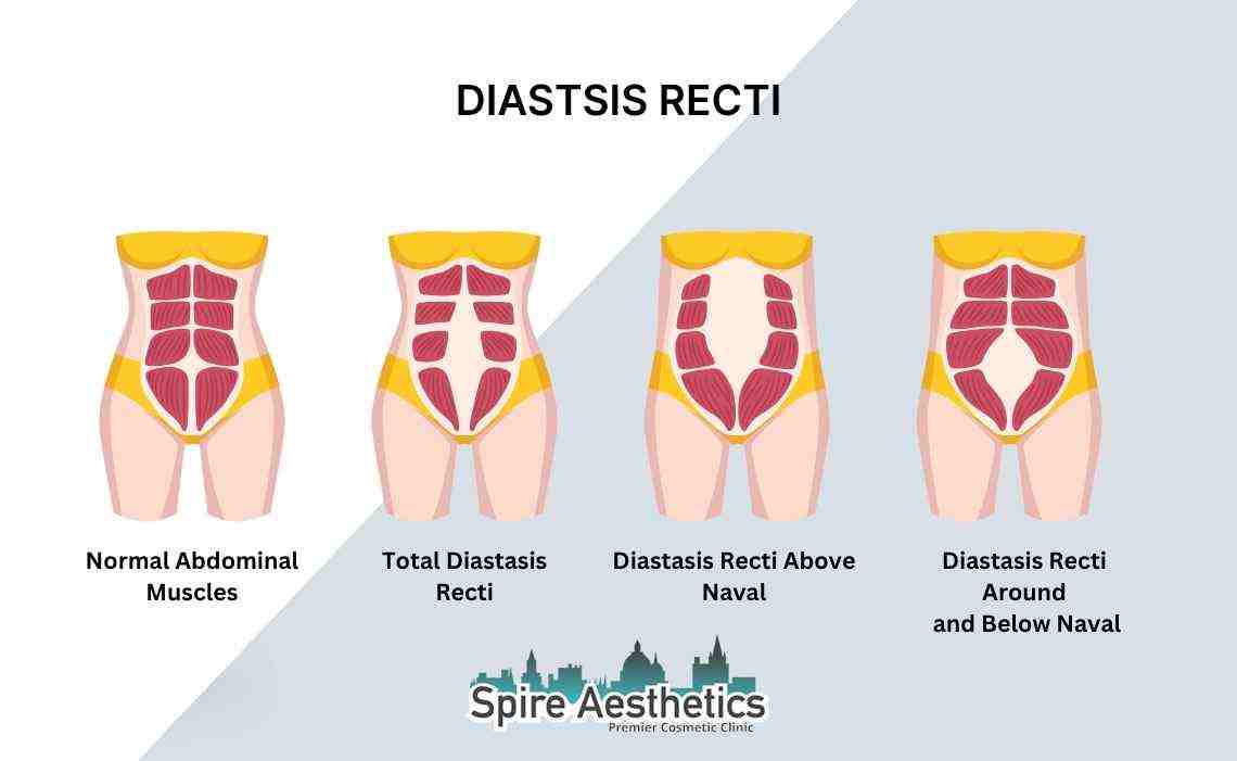 Is Non-Surgical Diastasis Recti Treatment Right for You? Common Concerns Answered Bellshill